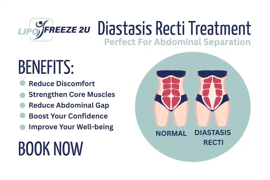 Benefits of body toning treatment Harpenden for Diastasis recti