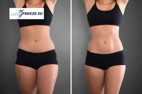 How Can LIPO FREEZE 2U Support Your Post-Pregnancy Body Recovery Harpenden?