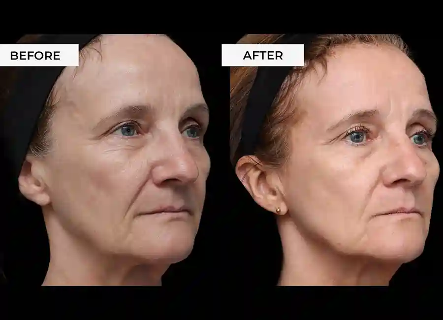 How Many RF Microneedling Sessions Will You Need to See a Difference Harpenden?