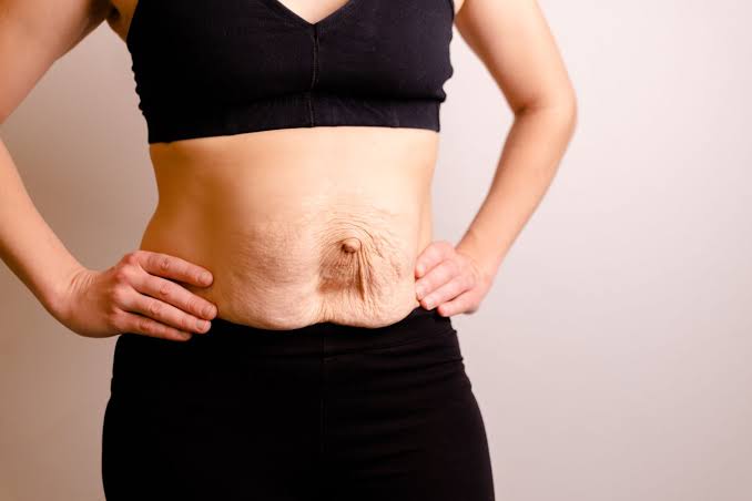 Is Surgery Really the Only Way to Repair Diastasis Recti Harpenden?